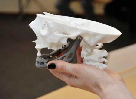 3D打印患者匹配下颌骨假体
