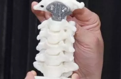 3D打印人工椎体