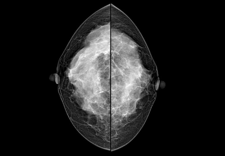 乳腺X射线系统