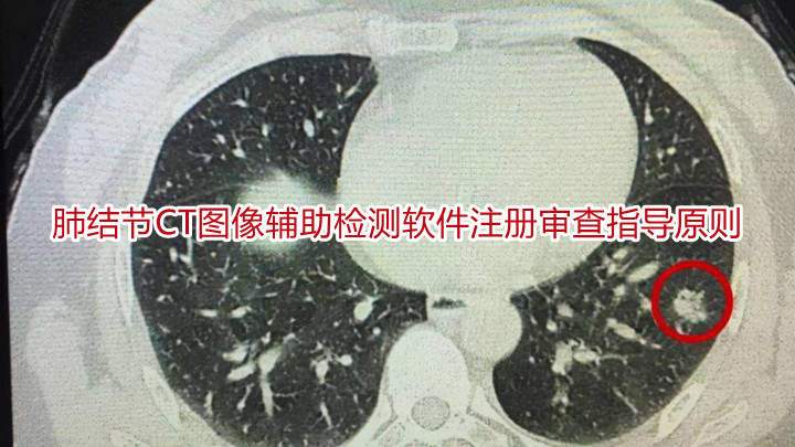 	  肺结节CT图像辅助检测软件注册审查指导原则