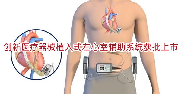 创新医疗器械植入式左心室辅助系统获批上市