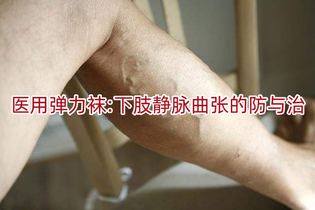 医用弹力袜:下肢静脉曲张的防与治
